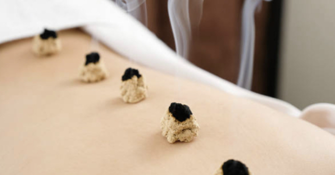 Moxibustion