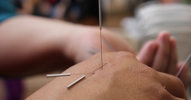 Traditional Chinese Medicine Acupuncture 