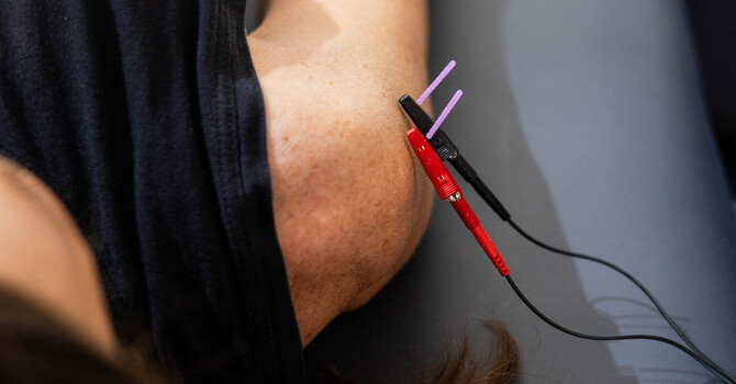 Functional Dry Needling vs. Acupuncture: What’s the Difference and How Does It Help Muscle Pain? image