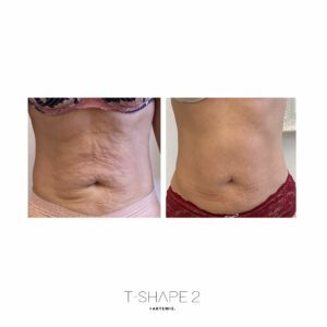 Body Contouring; Artemis TShape2; Lymphatic Drainage; Facial Rejuvination