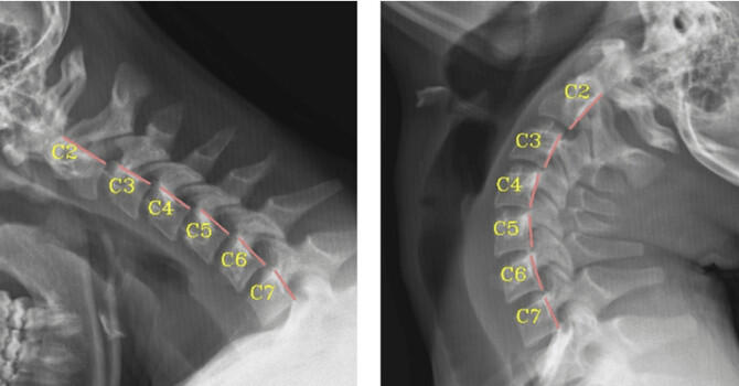 A Retrospective Cross-Sectional Analysis of Abnormal Cervical Mechanics in Patients with Scoliosis image