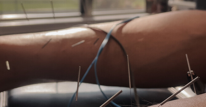 Dry Needling: A Modern Approach to Pain Relief and Muscle Healing image
