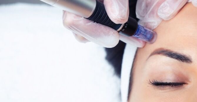 The Benefits of Microneedling: How Collagen Induction Therapy Renews Your Skin