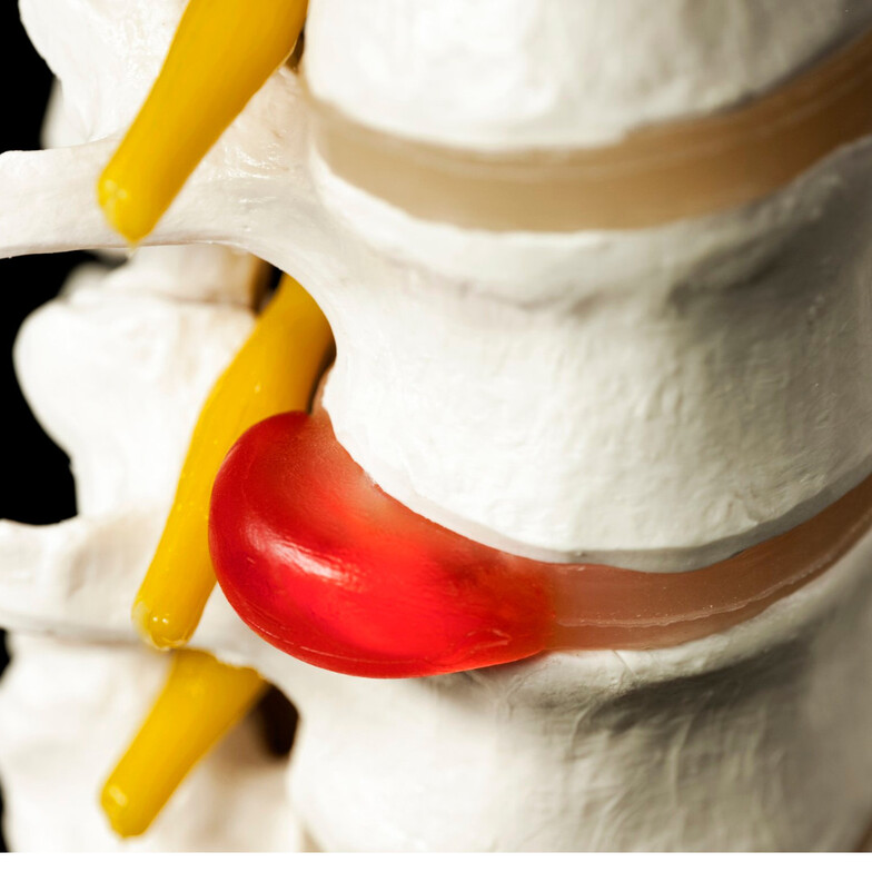 herniated or bulging disc relief